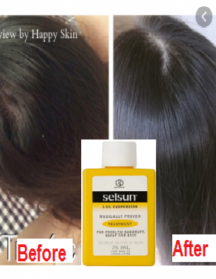 What is Selsun 2.5% 75ml? Effect of selsun 2.5%scalp fungus treatment